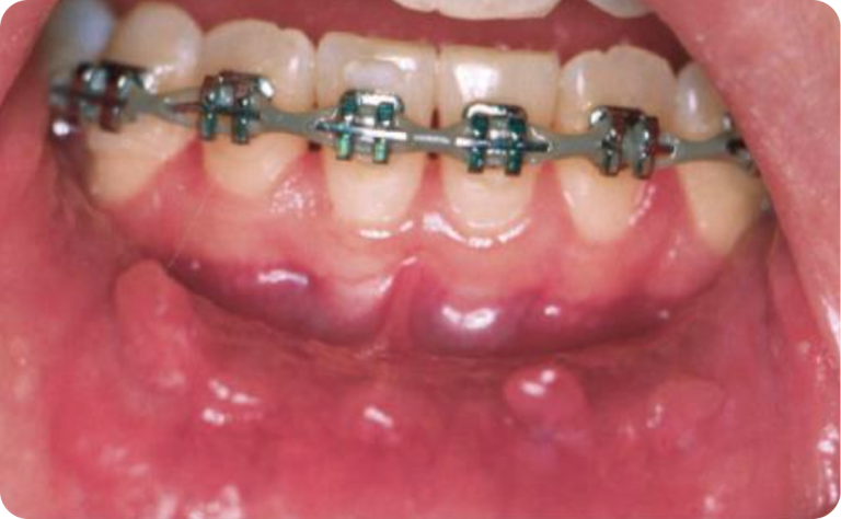 Gum irritation from braces, photo courtesy of the Canadian Association of Orthodontics