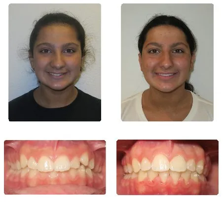 Before and after orthodontic treatment, patient 1