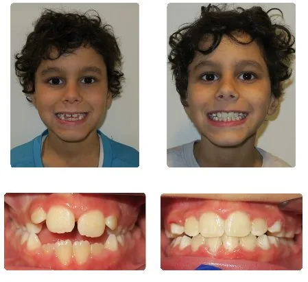 Before and after orthodontic treatment, patient 2