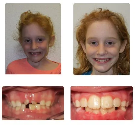 Before and after orthodontic treatment, patient 3