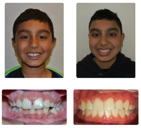 Before and after orthodontic treatment, patient 4