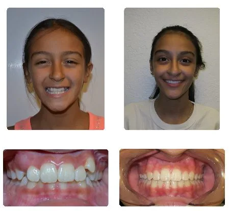 Before and after orthodontic treatment, patient 5