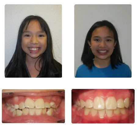 Before and after orthodontic treatment, patient 6