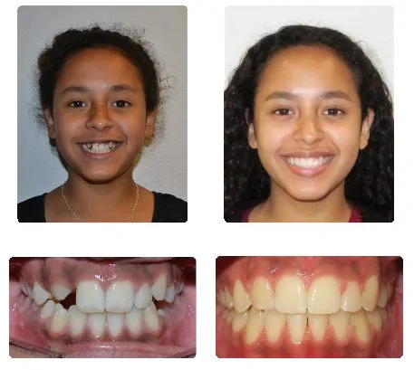 Before and after orthodontic treatment, patient 7
