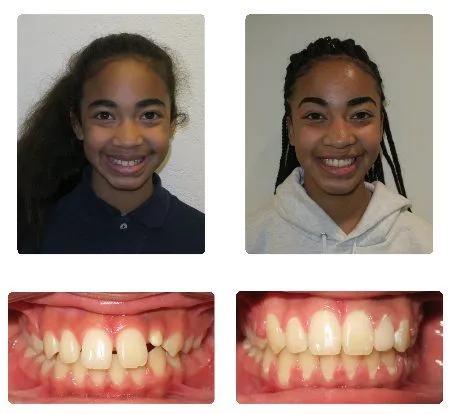 Before and after orthodontic treatment, patient 8