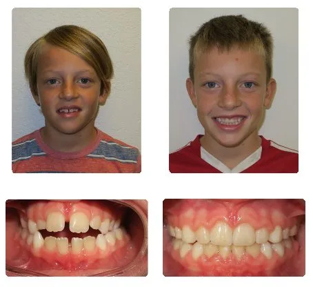Before and after orthodontic treatment, patient 9