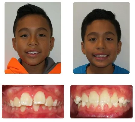 Before and after orthodontic treatment, patient 10