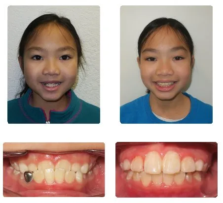 Before and after orthodontic treatment, patient 11