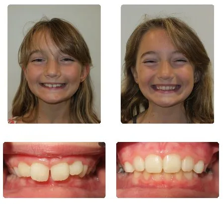 Before and after orthodontic treatment, patient 12
