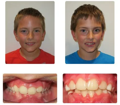 Before and after orthodontic treatment, patient 13