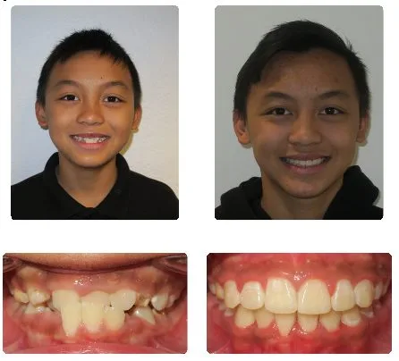 Before and after orthodontic treatment, patient 14