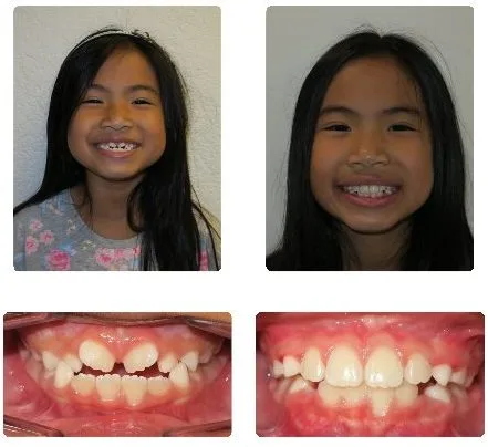 Before and after orthodontic treatment, patient 15