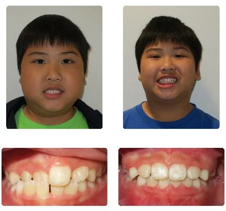 Before and after orthodontic treatment, patient 16