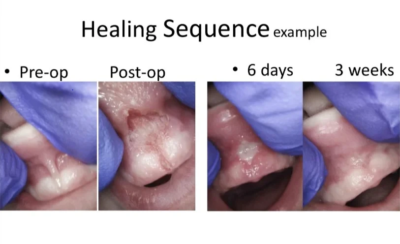 Healing sequence from pre-op through 3 weeks post-op