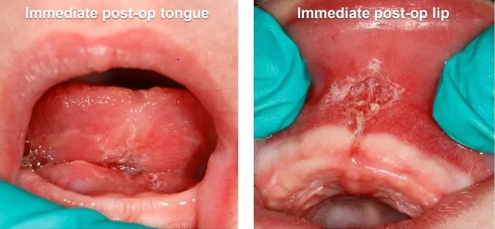 Tongue and lip immediately after a frenectomy