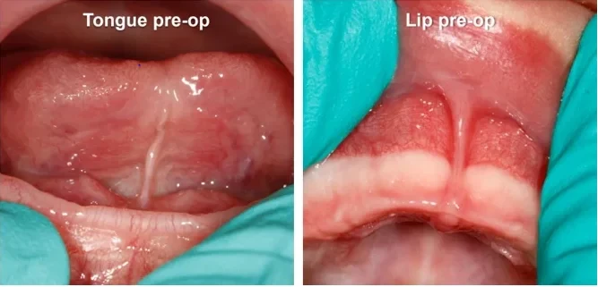 Tongue and lip frenulum before a frenectomy