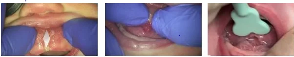 Demonstration of the tongue and lip stretch technique after a frenectomy
