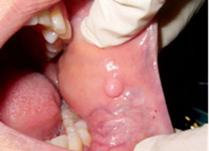 A mucocele lesion on the floor of the mouth prior to biopsy