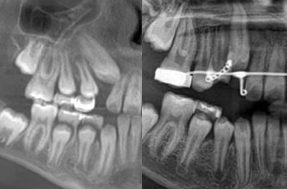 X-rays showing an impacted canine before and after an expose-and-bond procedure
